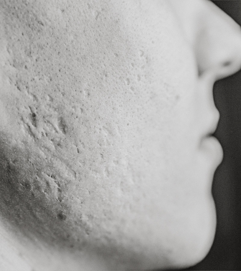 Acne Prone Skin