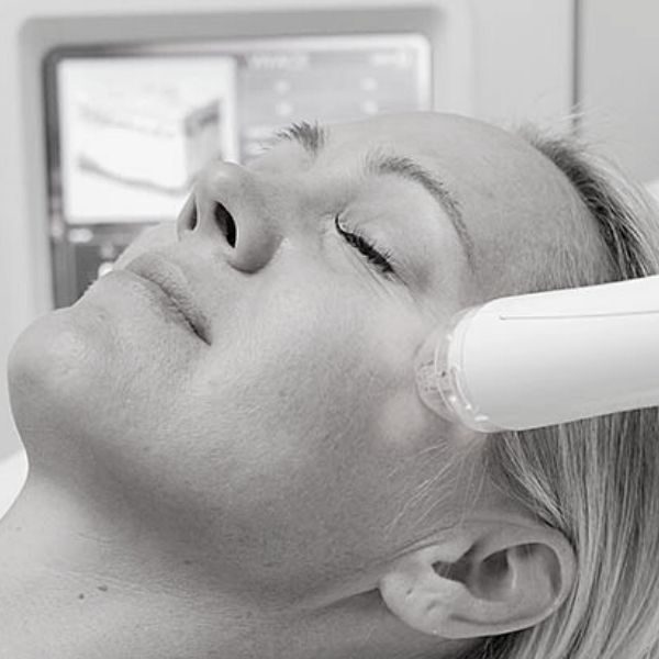 rf needling