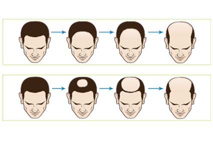 hair loss men