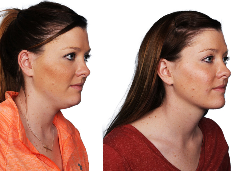 Kybella Treatment Results