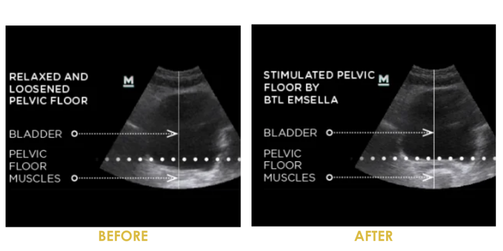 emsella before and after ultrasound