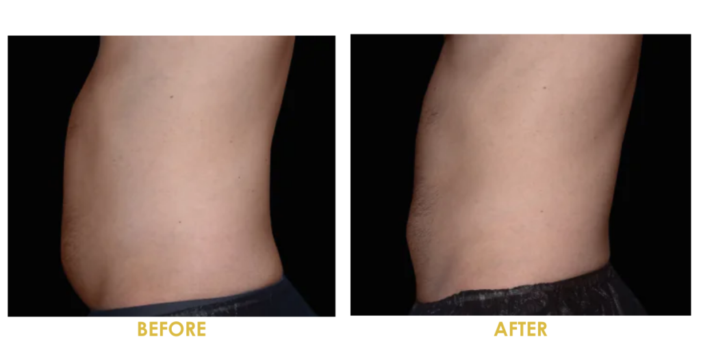 emsculpt before and after abdomen