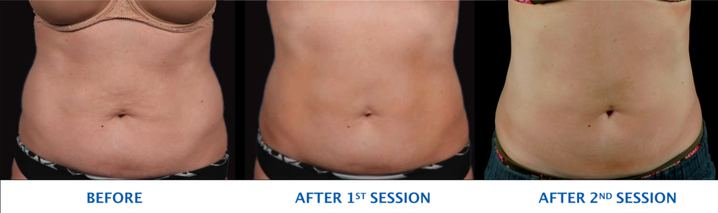 before and after photo after 2 sessions of coolsculpting