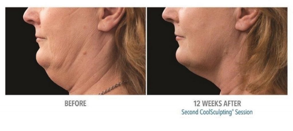 coolsculpting before and after chin