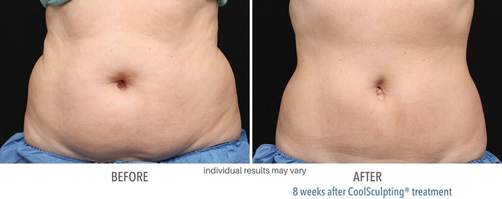 coolsculpting before and after treatment billings mt