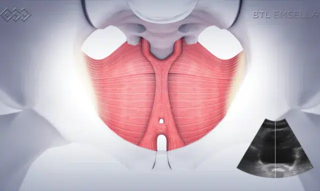 benefits of emsella