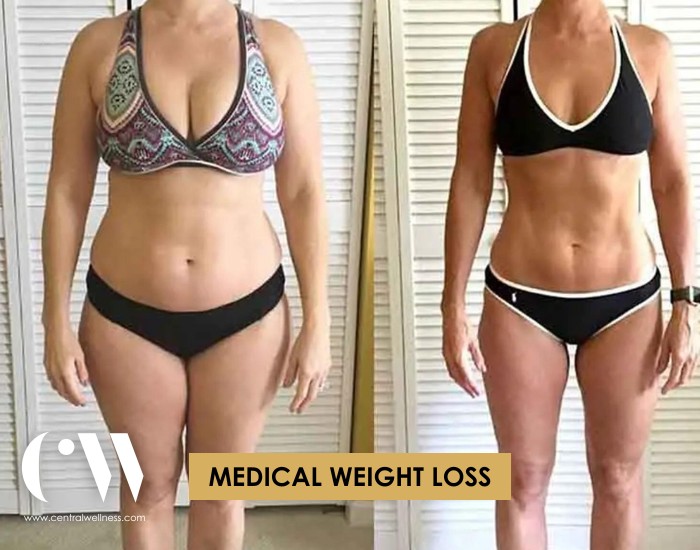 medical weight loss billings