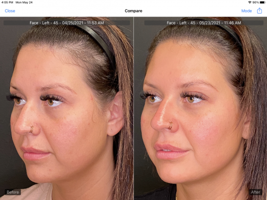 BO Botox upper face rejuvenation and brow asymmetry correction. 4.26.21 5.24.21
