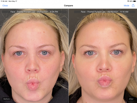 BP Botox Pursed Lips. Upper face Botox only 5.3.21 5.16.21