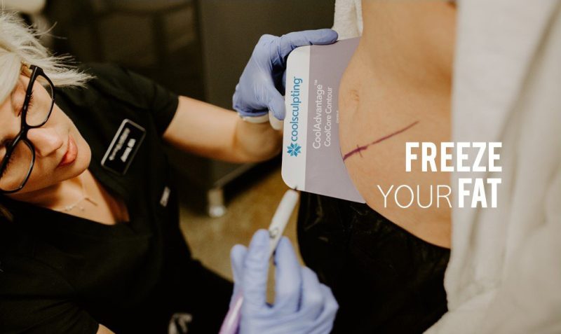 Coolsculpting Billings MT